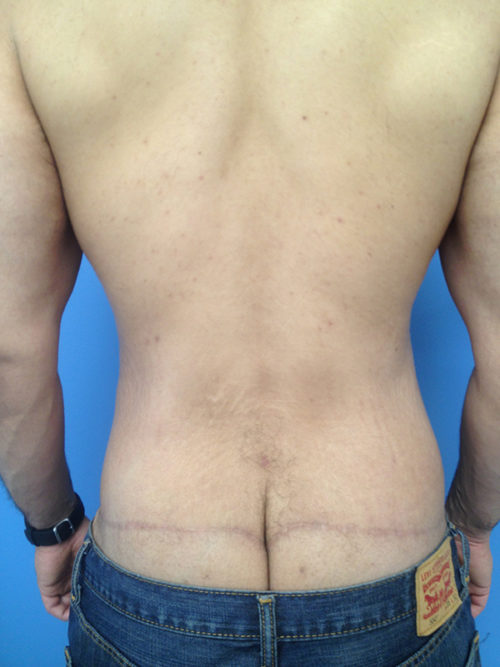 Male Abdominoplasty/Body Lift Case 407 After Photo Male Abdominoplasty/Body Lift