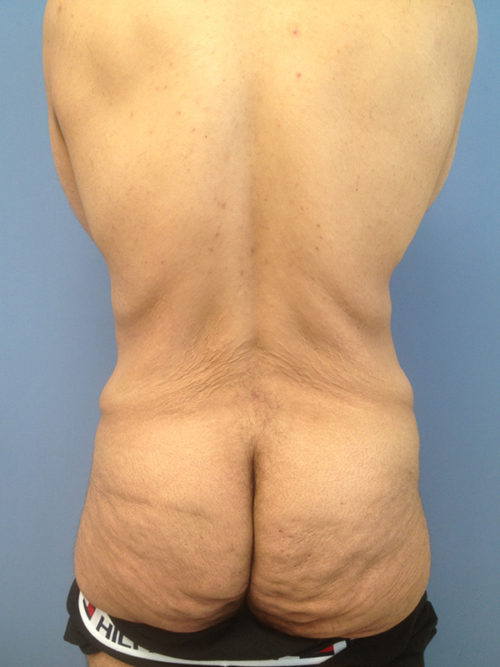 Male Abdominoplasty/Body Lift Case 407 Before Photo Male Abdominoplasty/Body Lift