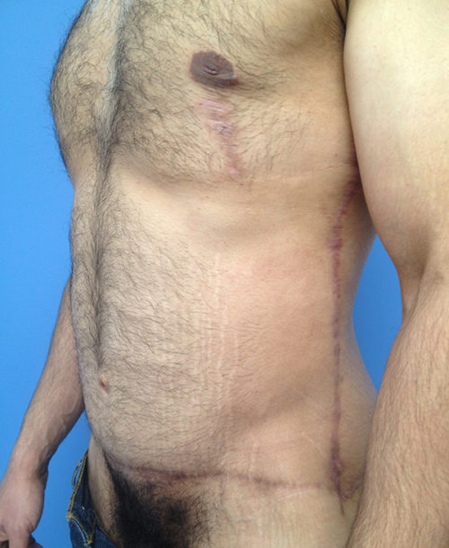 Male Abdominoplasty/Body Lift Case 407 After Photo Male Abdominoplasty/Body Lift