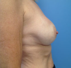 Breast Augmentation