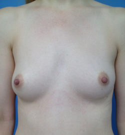 Breast Augmentation