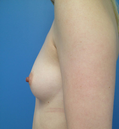 Breast Augmentation Case 440 Before Photo Breast Augmentation