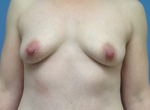 Breast Augmentation Case 442 Before Photo Breast Augmentation