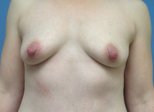 Breast Augmentation