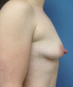 Breast Augmentation