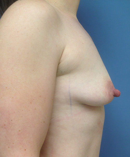 Breast Augmentation Case 442 Before Photo Breast Augmentation
