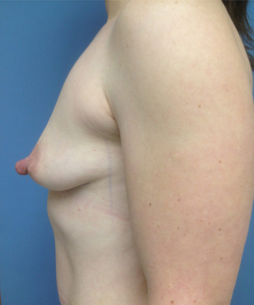 Breast Augmentation Case 442 Before Photo Breast Augmentation