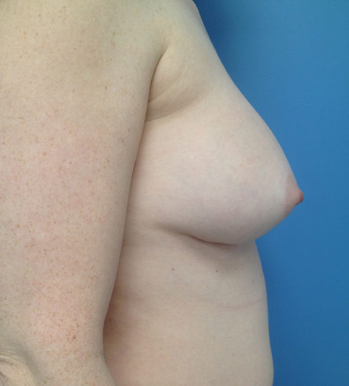 Breast Augmentation Case 443 After Photo Breast Augmentation