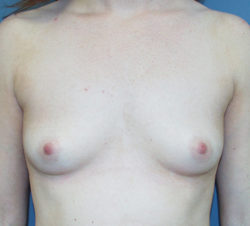 Breast Augmentation