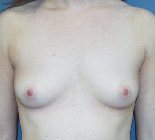 Breast Augmentation Case 443 Before Photo Breast Augmentation