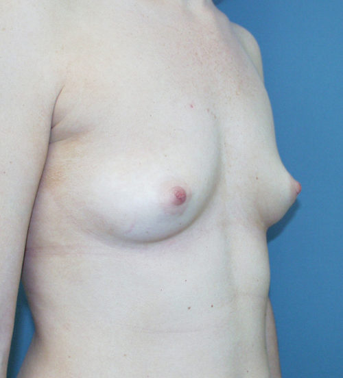 Breast Augmentation Case 443 Before Photo Breast Augmentation