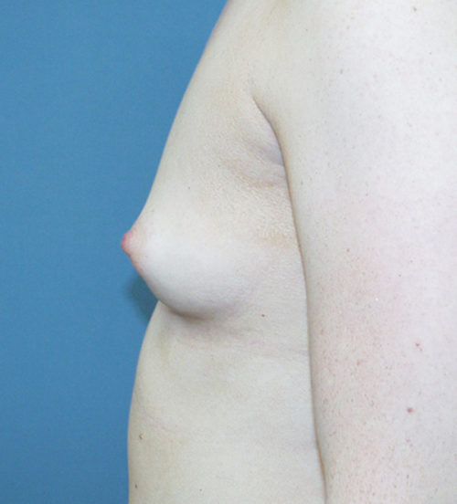 Breast Augmentation Case 443 Before Photo Breast Augmentation