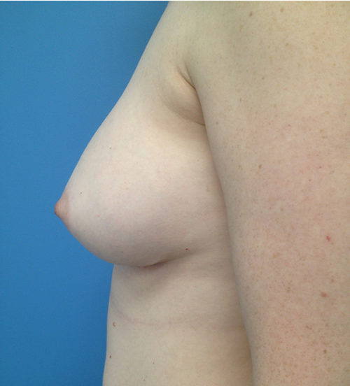 Breast Augmentation Case 443 After Photo Breast Augmentation