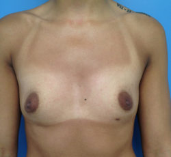 Breast Augmentation