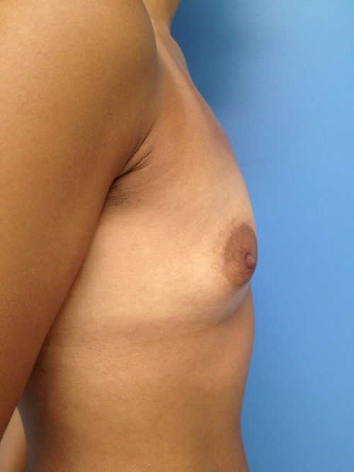 Breast Augmentation