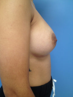 Breast Augmentation