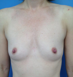 Breast Augmentation