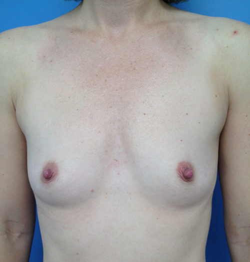 Breast Augmentation Case 445 Before Photo Breast Augmentation