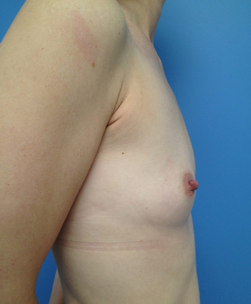 Breast Augmentation Case 445 Before Photo Breast Augmentation