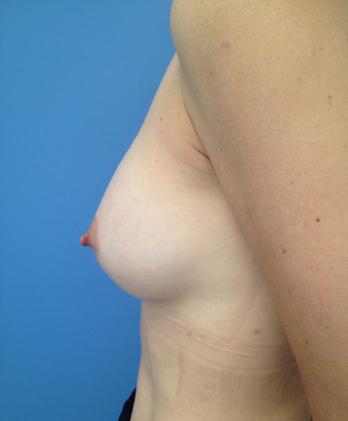 Breast Augmentation Case 445 After Photo Breast Augmentation