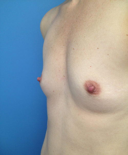 Breast Augmentation Case 445 Before Photo Breast Augmentation