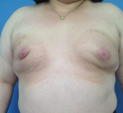 Breast Augmentation