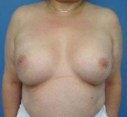 Breast Augmentation