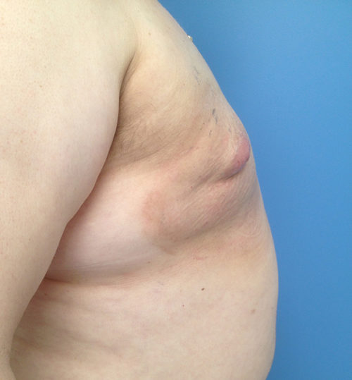 Breast Augmentation