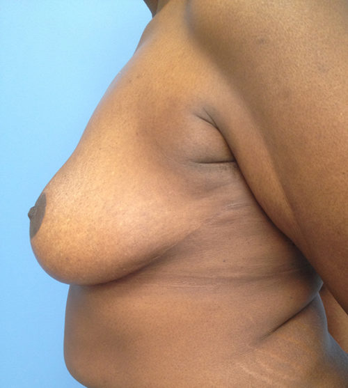 Breast Lift Case 527 After Photo Breast Lift