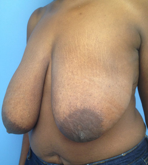 Breast Lift Case 527 Before Photo Breast Lift