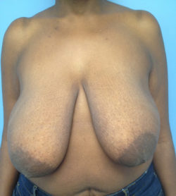 Breast Lift