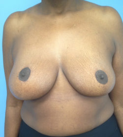 Breast Lift