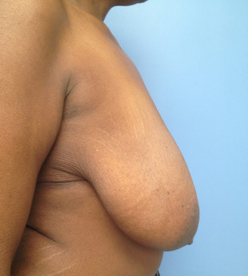 Breast Lift Case 527 Before Photo Breast Lift