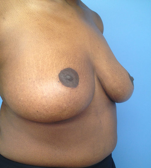 Breast Lift Case 527 After Photo Breast Lift