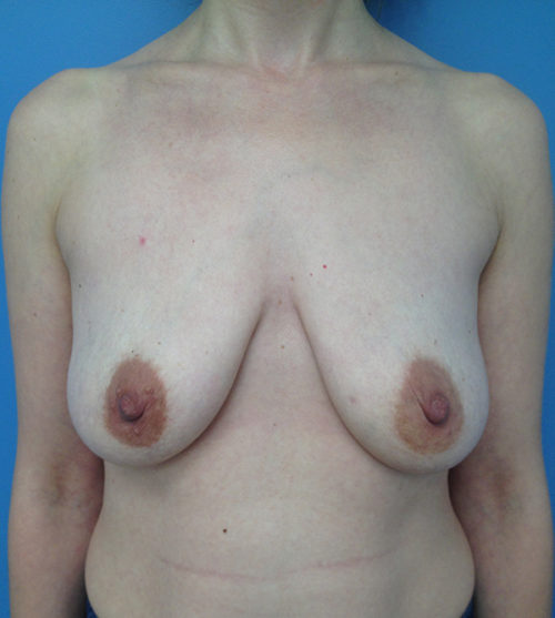 Breast Lift Case 528 Before Photo Breast Lift