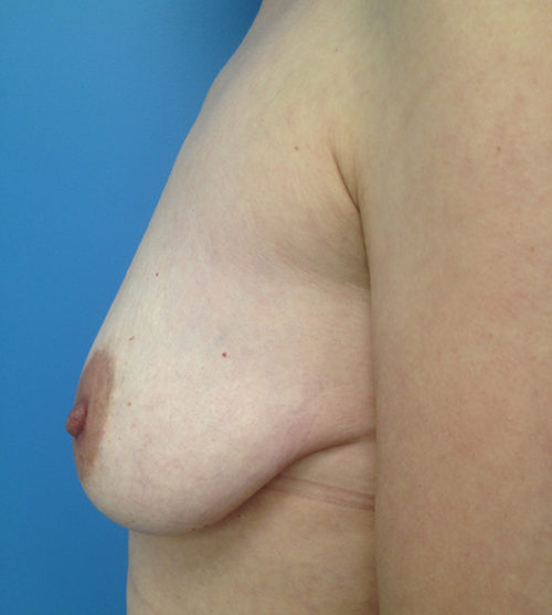 Breast Lift Case 528 Before Photo Breast Lift