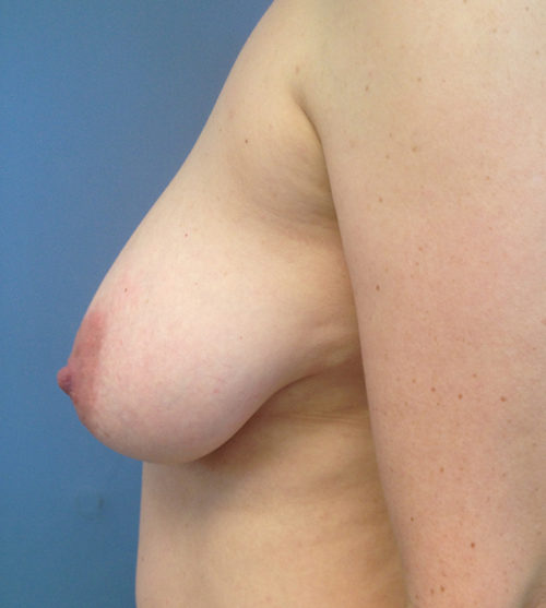 Breast Reduction Case 568 Before Photo Breast Reduction