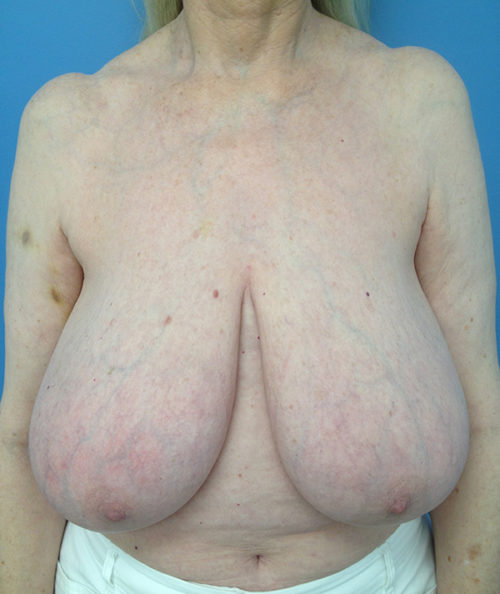 Breast Reduction Case 569 Before Photo Breast Reduction