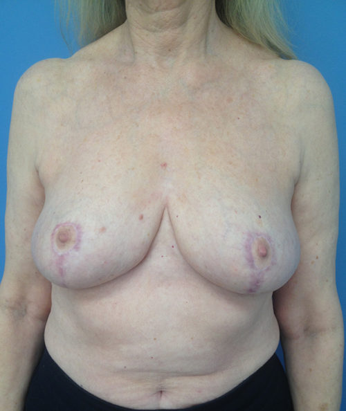 Breast Reduction Case 569 After Photo Breast Reduction