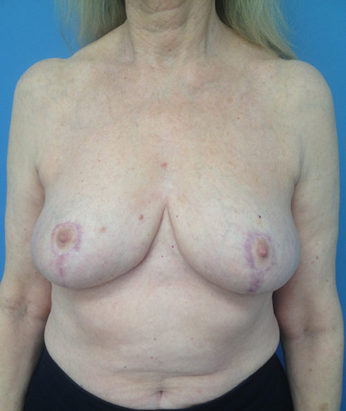 Breast Reduction