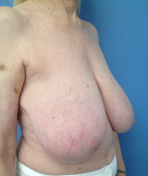 Breast Reduction Case 569 Before Photo Breast Reduction
