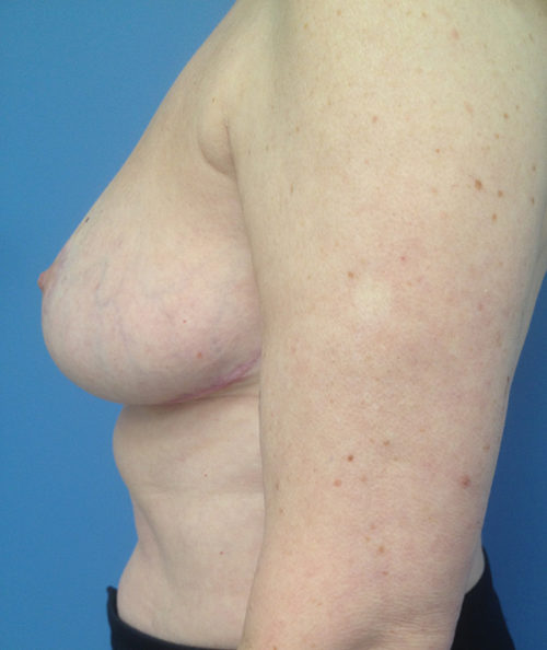 Breast Reduction Case 569 After Photo Breast Reduction