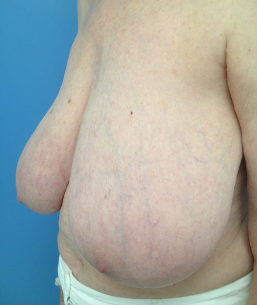 Breast Reduction Case 569 Before Photo Breast Reduction