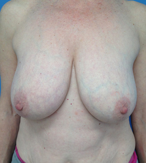 Breast Reduction Case 570 Before Photo Breast Reduction