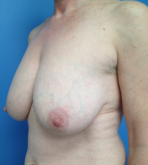 Breast Reduction Case 570 Before Photo Breast Reduction