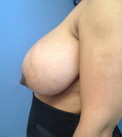 Breast Reduction