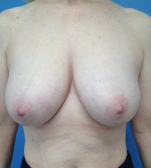 Breast Reduction