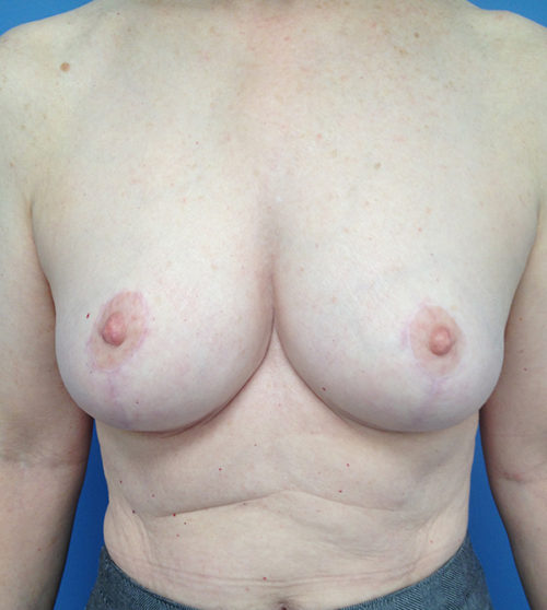 Breast Reduction