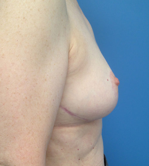 Breast Reduction