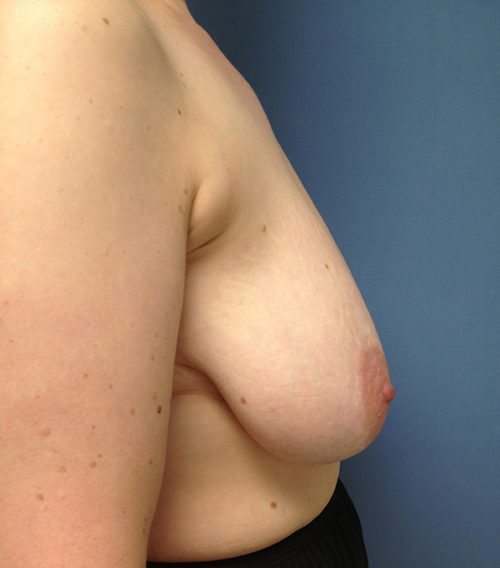 Breast Reduction